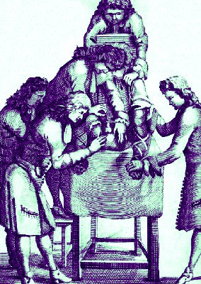 Performing a Lithotomy in the 17th century